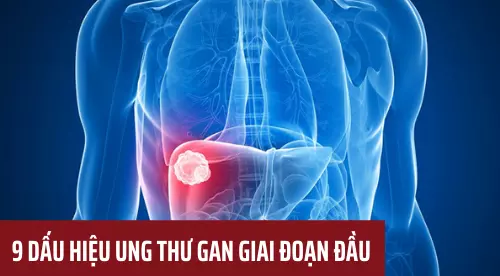 Top 9 dấu hiệu ung thư gan giai đoạn đầu ai cũng nên biết